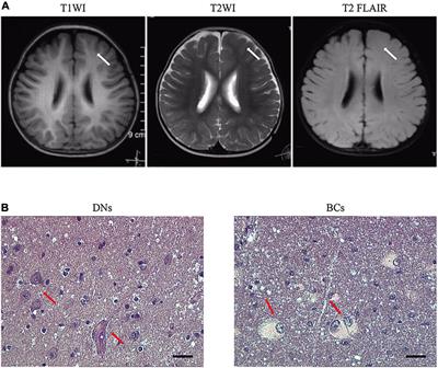 Brain Somatic Variant in Ras-Like Small GTPase RALA Causes Focal Cortical Dysplasia Type II